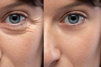 आंखों के आसपास झुर्रियां, Eye Wrinkles, Skin Care Tips, Anti Aging Tips, Beauty Tips Hindi, Dermatologist Tips, Face Wrinkles, Healthy Skin Tips